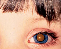 Çocukların gözündeki parıltı tümörün habercisi olabilir